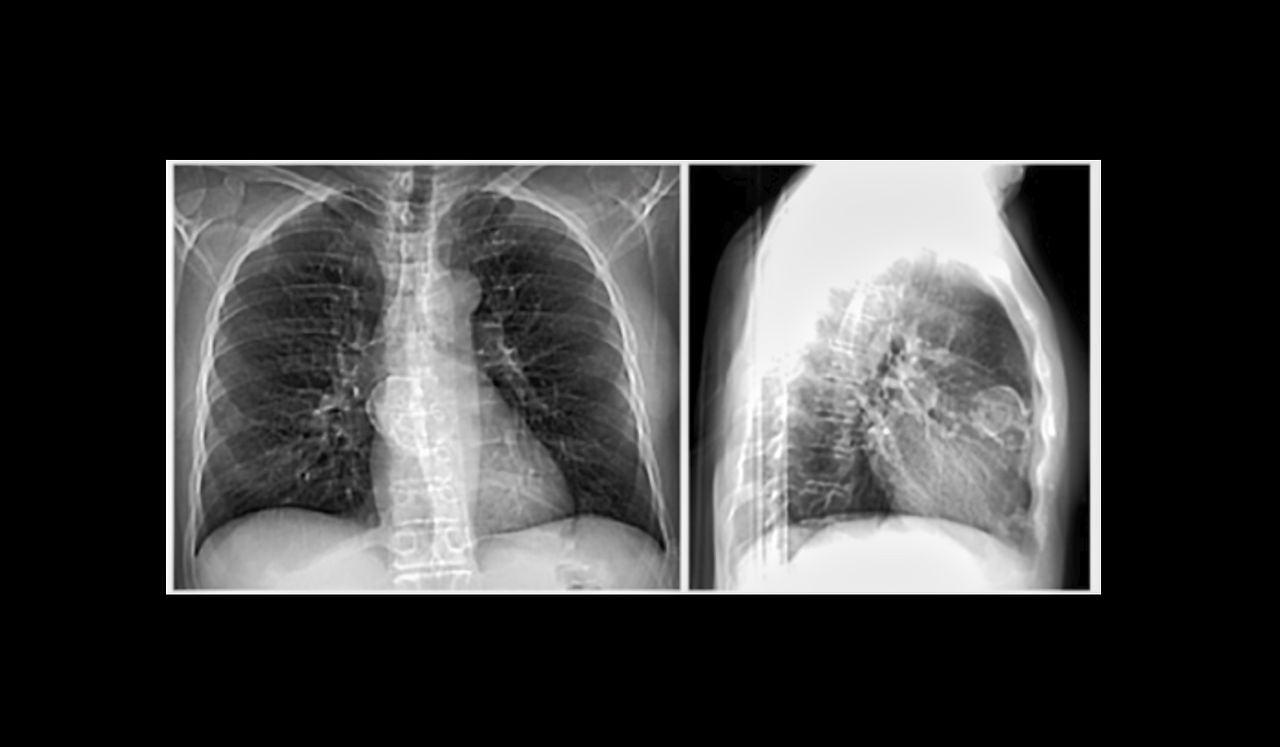 Dr. Segnini mediastino imágenes tomografía radiografía radiología