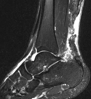 Musculoskeletal imaging ankle tendon Achilles ultrasound diagnosis