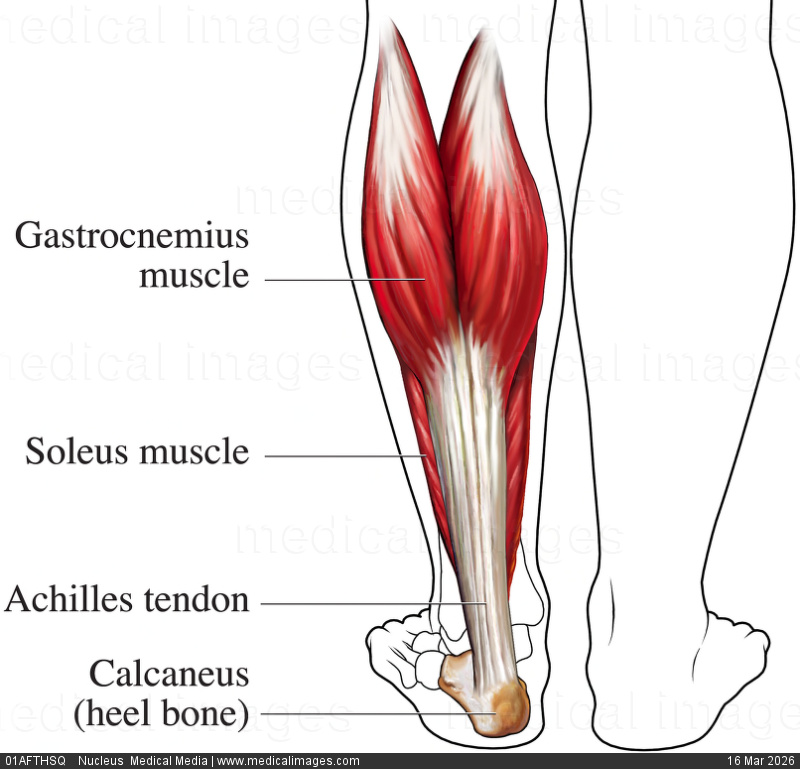 Achilles tendon injury sports athlete critical zone tendinopathy