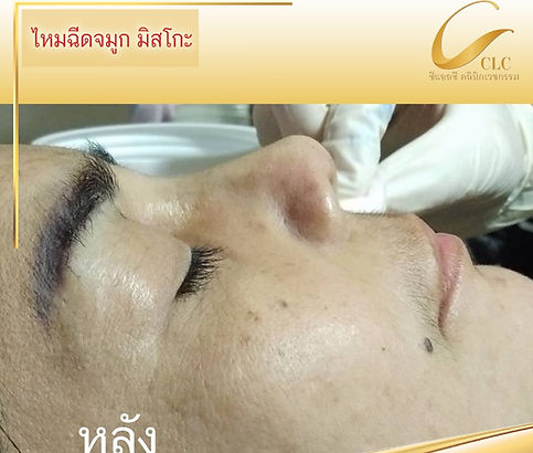 6.ทำจมูก-อุบล-4.jpg