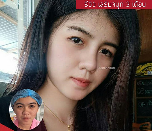 3-4หมอไหนเสริมจมูก อุบลสวย.jpg
