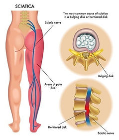 Sciatica Nerve and Pain-resized.jpg