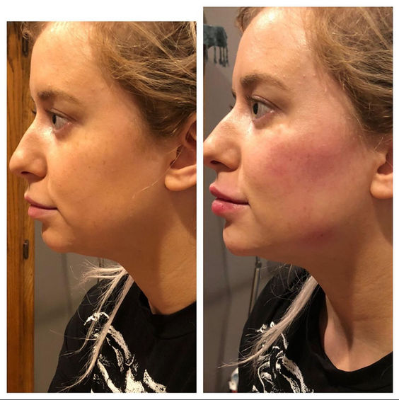 Chin and jawline filler
