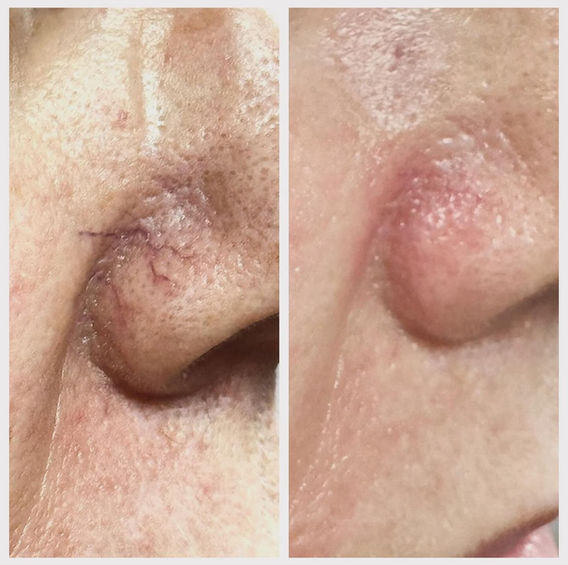 Vein Removal