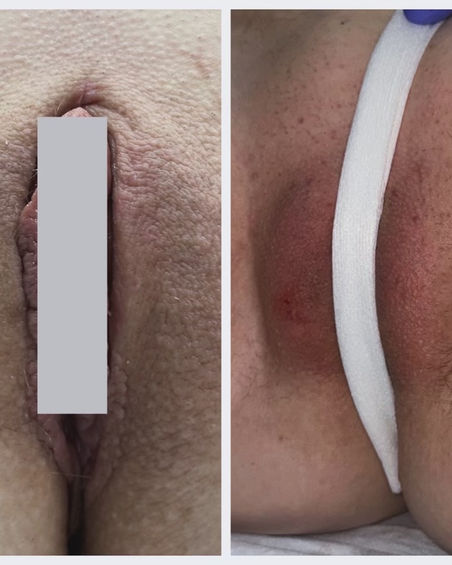 Labial puff before and after