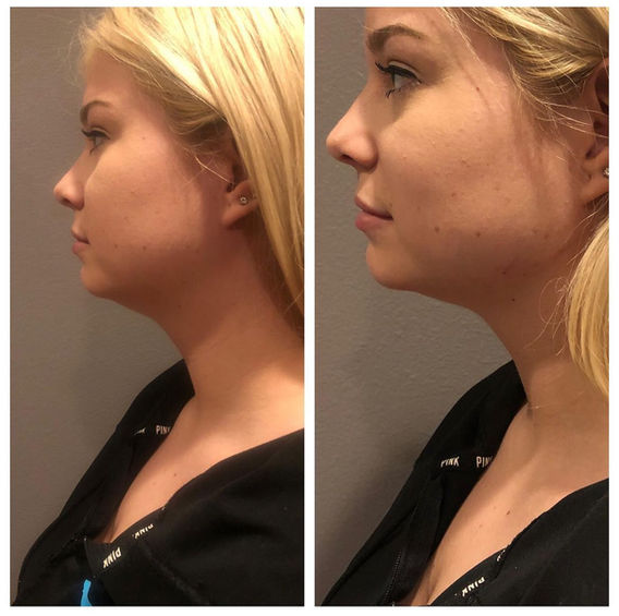 Chin and jawline filler