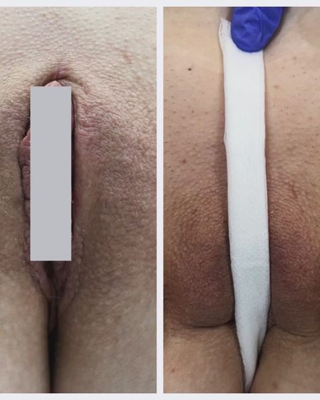 Labial puff
