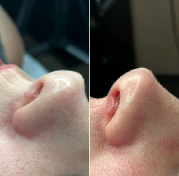 Vein Removal