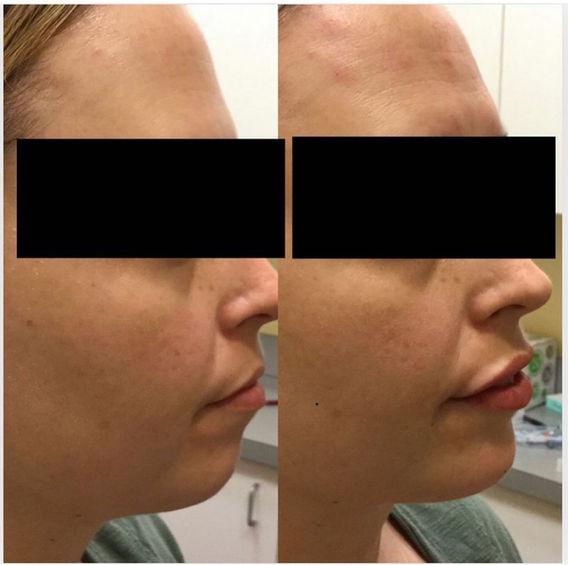 Chin and jawline filler