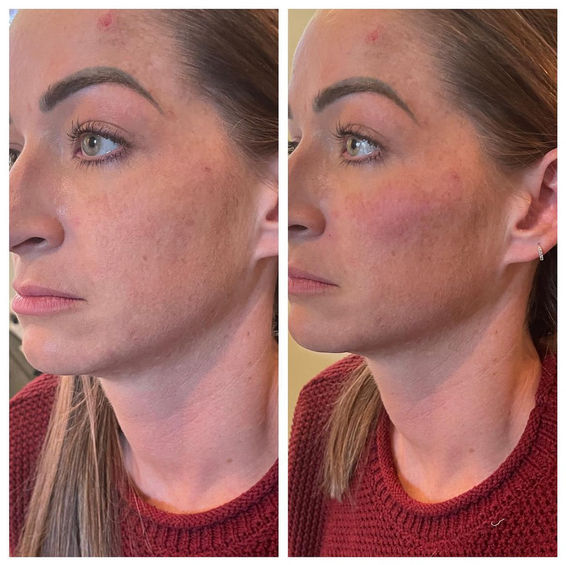 Cheek filler