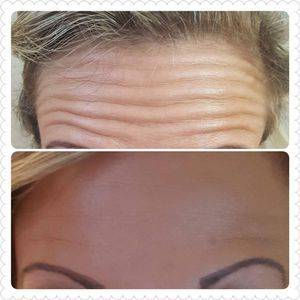 Wrinkle Relaxation Treatment Liverpool