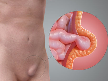 Inguinal Hernia: A Comprehensive Review of Anatomy, Clinical Features, and Surgical Management