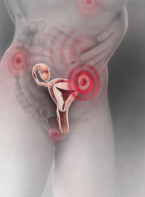 Mehr als Menstruationsschmerzen: Der Beobachter-Artikel klärt über die weit verbreitete Krankheit Endometriose auf, enttabuisiert und schafft Sichtbarkeit. Lucy Kägi Illustration