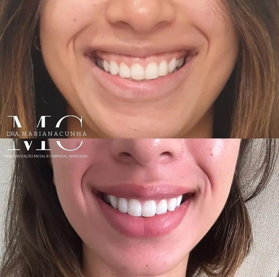 Botox para Sorriso Gengival.jpeg