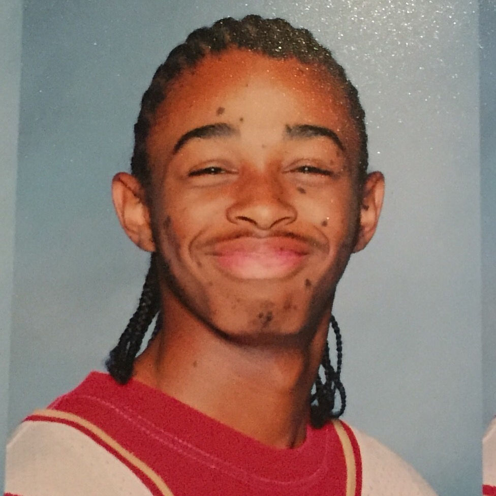 A young man smiles with a closed mouth, posing happily for the camera. It appears to be a yearbook photo. His hair is braided and his braids touch right down at his shoulders. His eyes are smiling too, giving a very proud appearance. He has several small nevi scattered across his face and neck.
