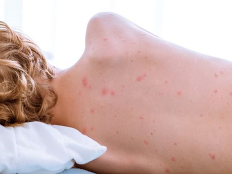 Herberth Cuba / Chile y el caso de sarampión importado¡