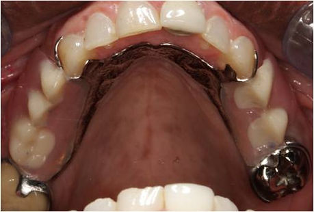 Bridge and denture 1 B.jpg