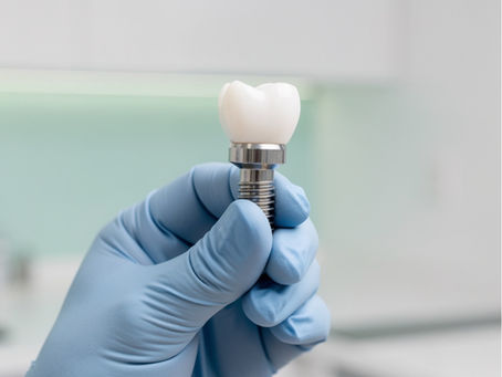 Implantes dentários: quando são indicados e como cuidar deles depois . Um guia rápido e direto para quem está pensando em repor um dente perdido com um implante.Vangogh Odontologia