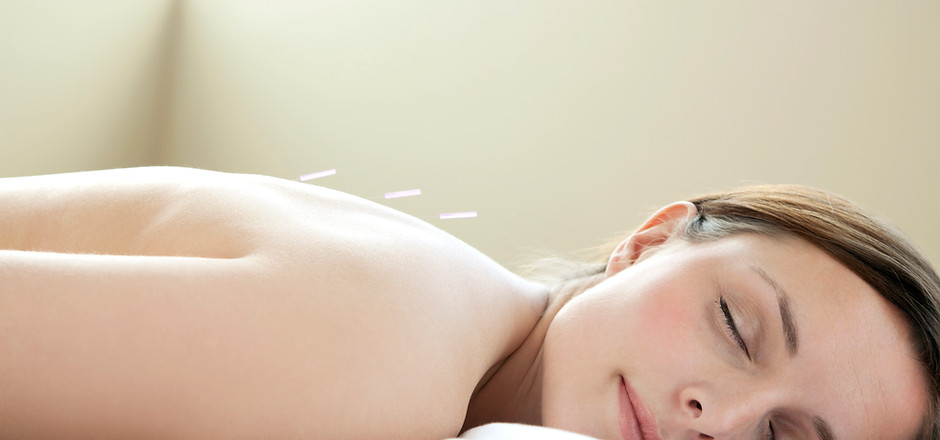 Acupuncture