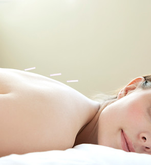 Acupuncture
