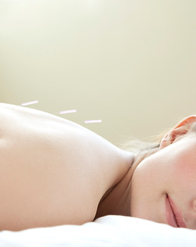 Acupuncture