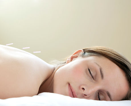 Acupuncture