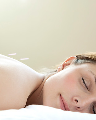 Acupuncture
