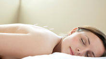 What is Acupuncture?