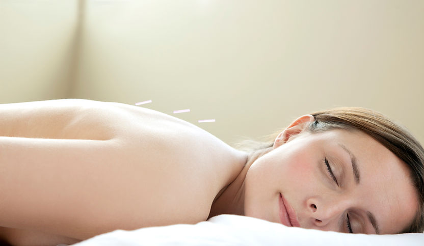 Acupuncture