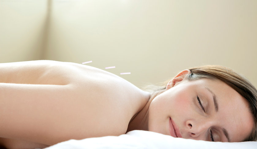 Acupuncture Treatment