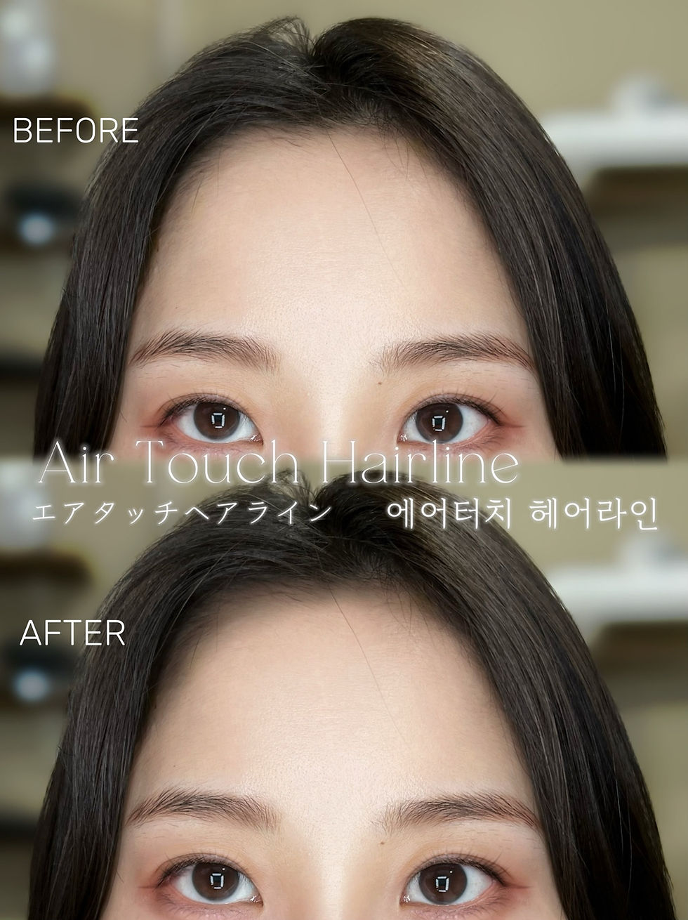 Before and after hairline tattoo and scalp micropigmentation at INMOREBEAUTY SEOUL