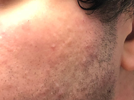 Problème de peau (après)