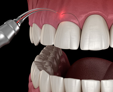 Gingivectomy for healthy and balanced gums