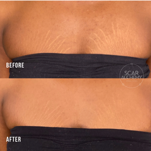 STRETCH MARK CAMOUFLAGE - Breast Stretch Marks