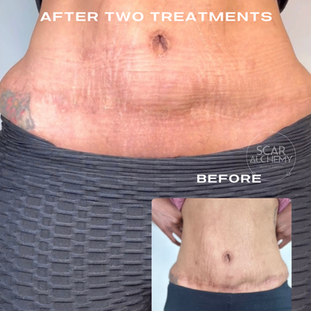 Tummy Tuck scar, C-section scar ,Abdominal surgery scar