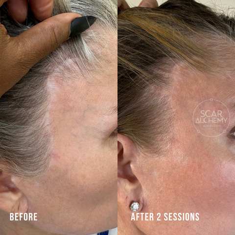 facelift scar/scar camouflage