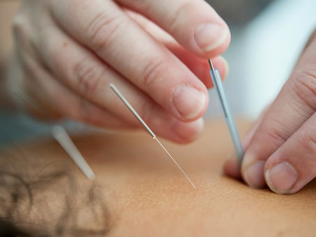 Acupuncture