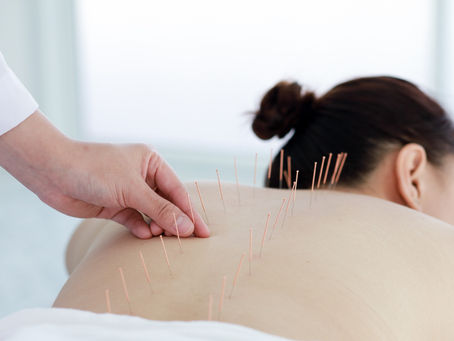 woman receiving acupuncture treatment