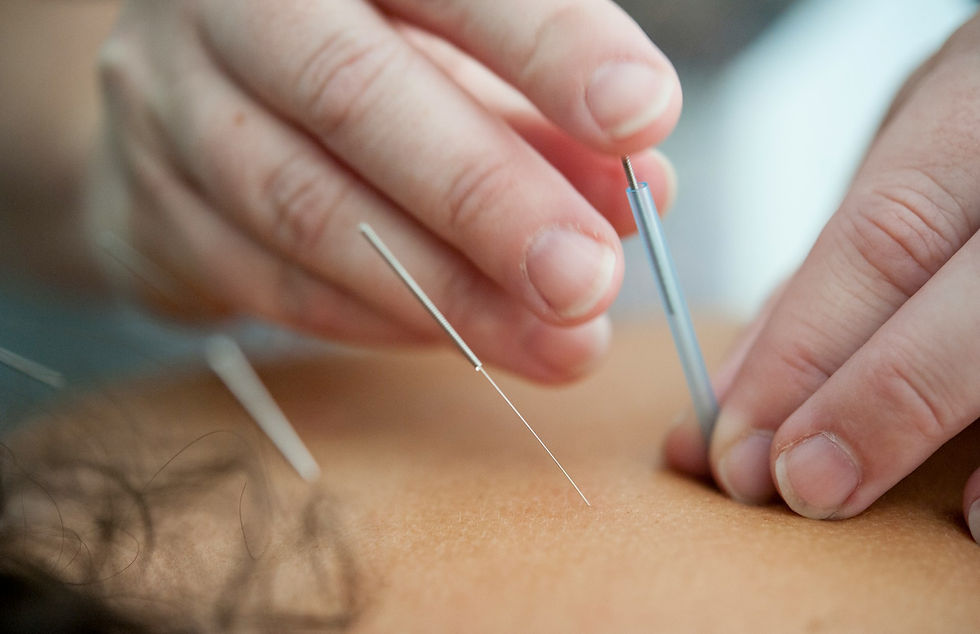 How Longmont Uses Acupuncture for Chronic Pain Routines