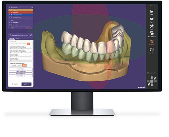 ExoCad denture
