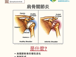 肩膊骨關節炎:文獻概要