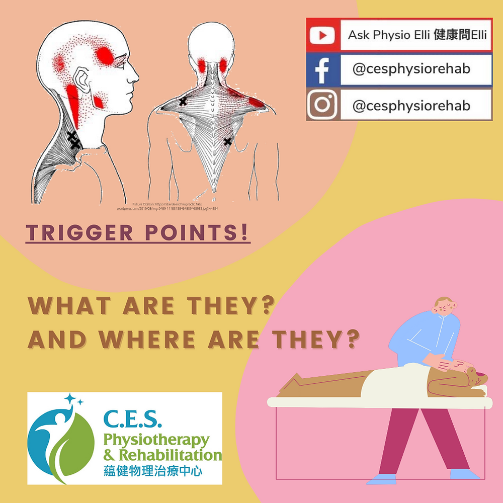 Trigger Points – What Are They?