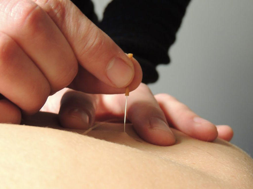 dry-neelding-fysiotherapie-1-1024x768.jp