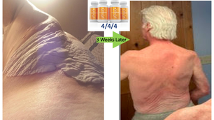 [Audio] Regeneration of Inactive Hand, Clean Skin: Dante, Age 68 