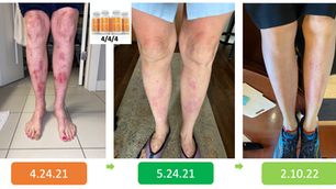 Amy’s Skin Issues are Relieved after Years of Sores