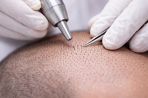 Transplante capilar FUE: extração de unidades foliculares da área doadora com punch