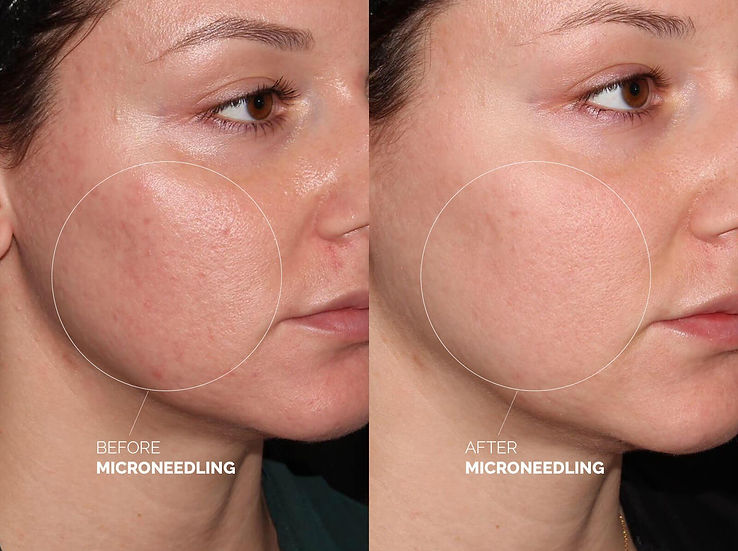microneedling-before-after-2.jpg