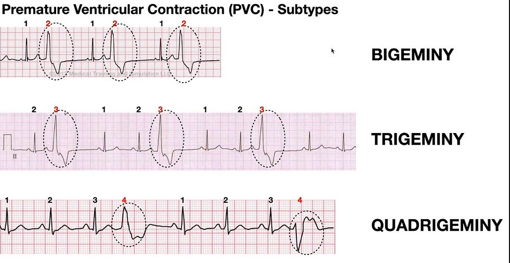 Contracoes Ventriculares Prematuras Trigeminismo Arritmias Card acas Contracoes Ventriculares Prematuras Trigeminismo Arritmias Card acas