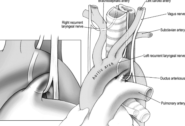 coarctação da aorta.