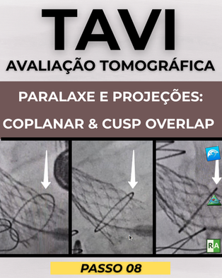 Avaliação tomográfica para TAVI: paralaxe, projeções Coplanar e Cusp Overlap